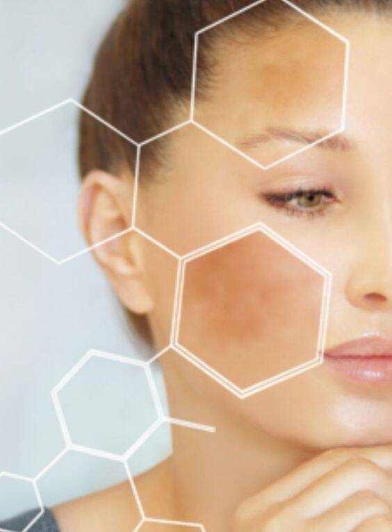 Melasma Treatment