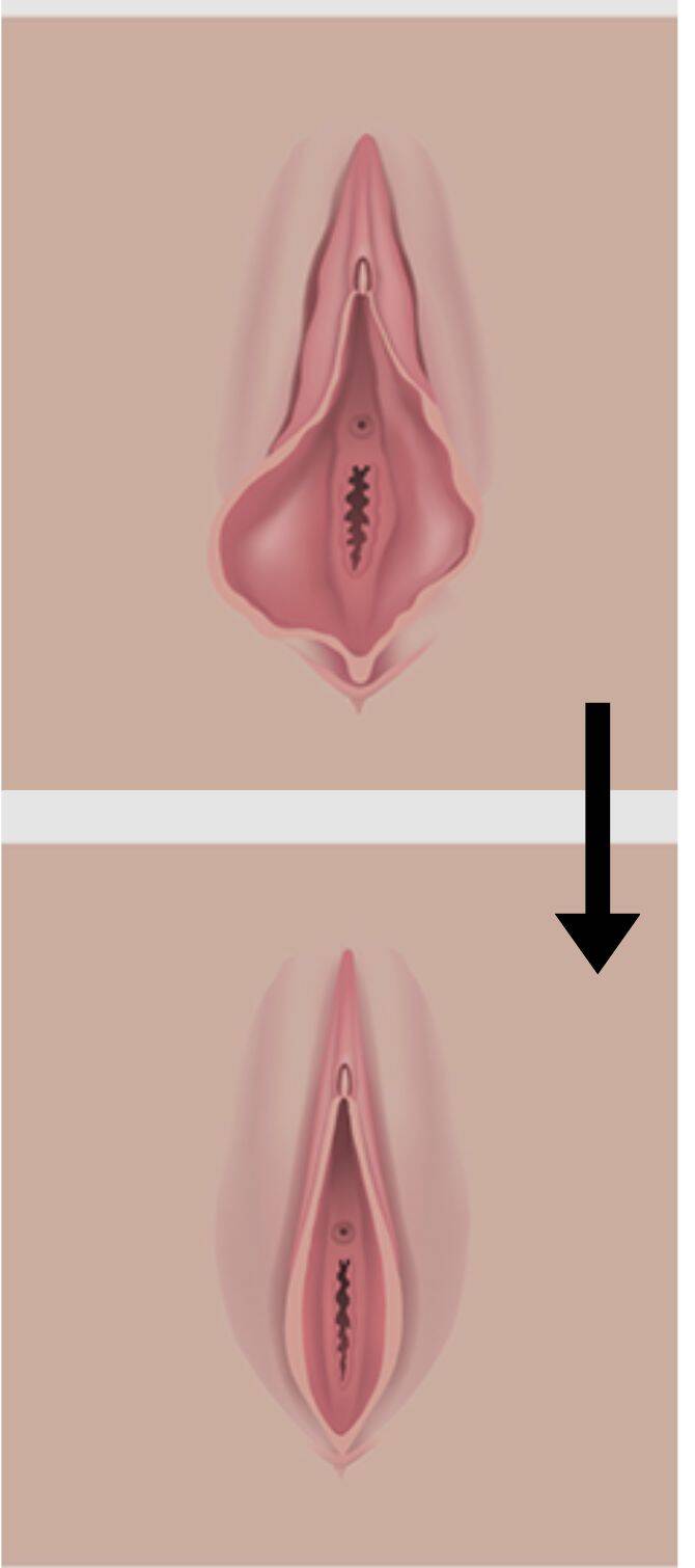 Rx vaginal Tightening
