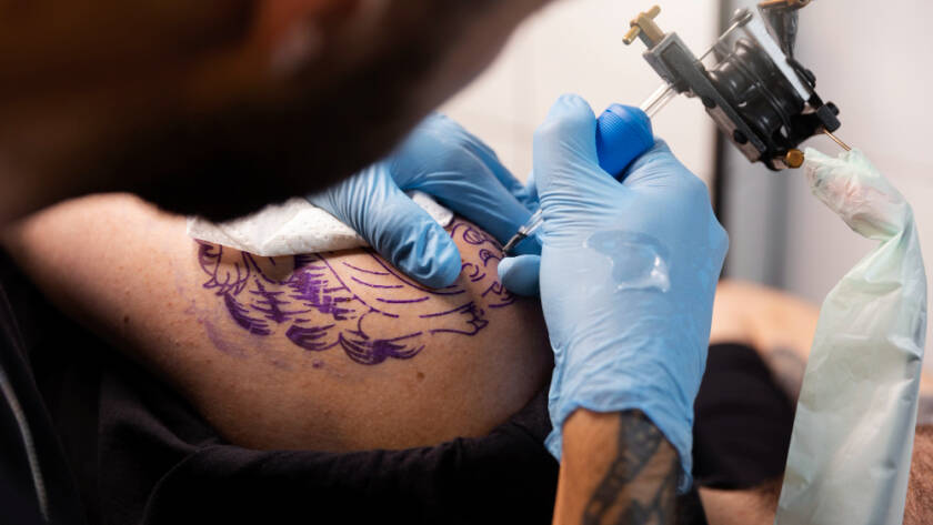 Tatto Removal