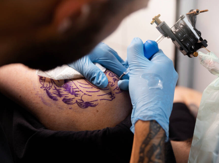 Tatto Removal