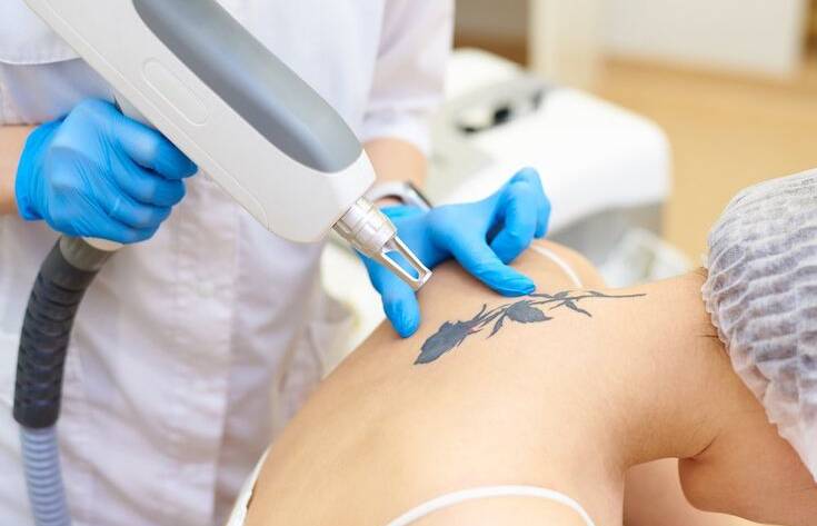 Laser Tattoo Removal