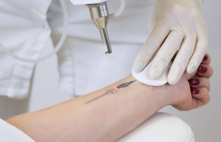 Achieve Complete Tattoo Removal with Lasers in Delhi at RxRejuvenate