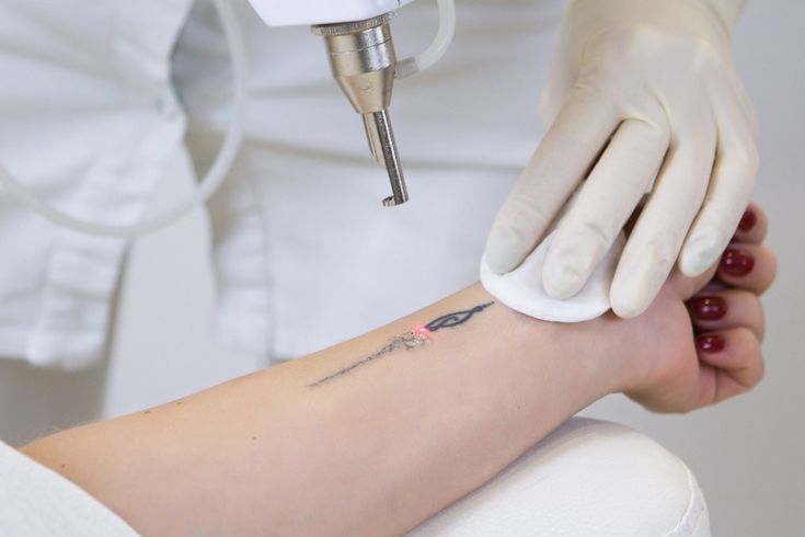 Achieve Complete Tattoo Removal with Lasers in Delhi at RxRejuvenate