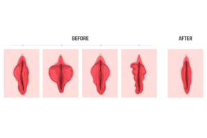 Vaginal Rejuvenation Demonstration of before & After