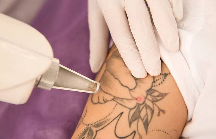 Tattoo Removal