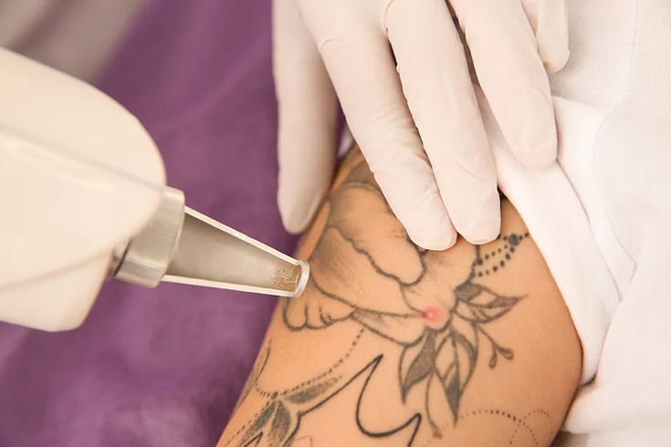 Tattoo Removal