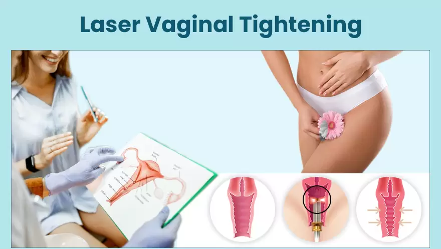 Laser Vaginal tightening