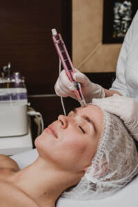 microneedling process
