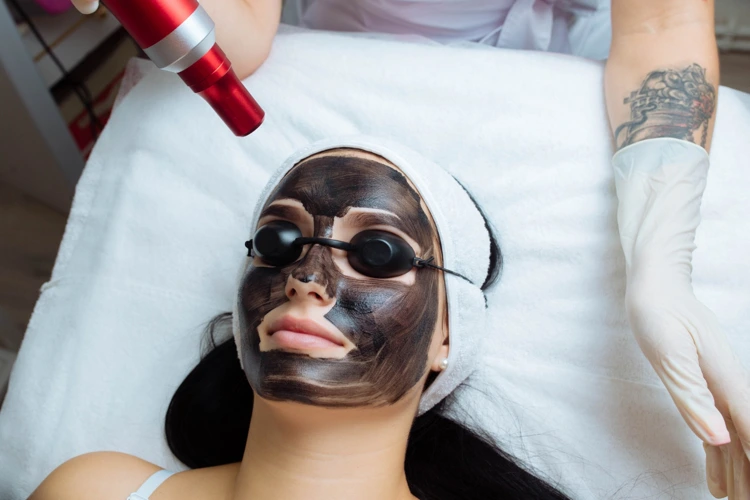 Carbon Facial Treatment