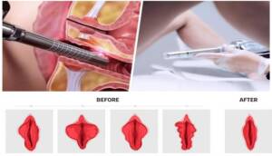 Demonstration Of Non-Surgical Vaginal Tightening