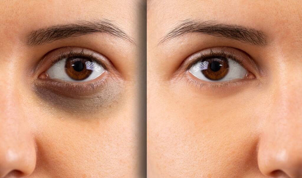 Dark Circles: Understanding Causes and Finding Solutions