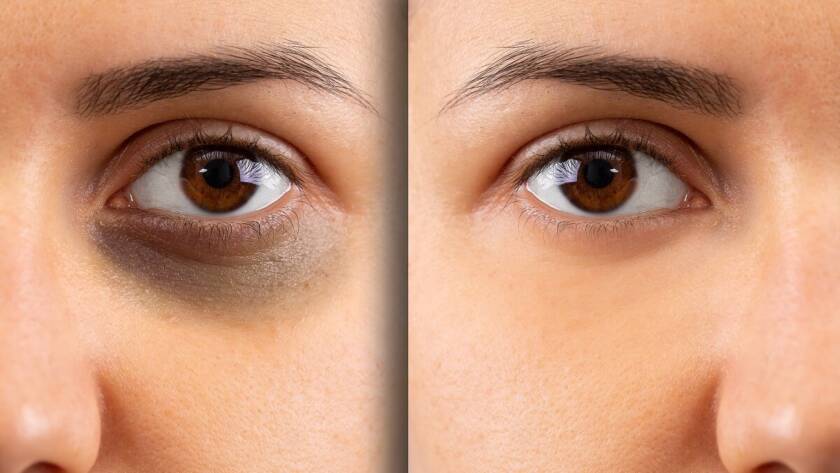 Dark circles treatments