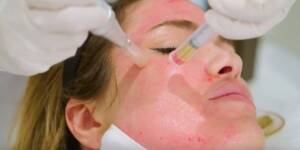 Vampire Facials Treatment