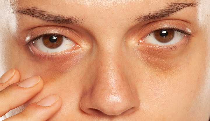 Dark circles treatments