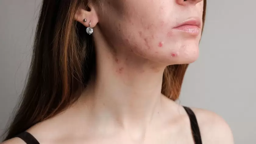 Acne Scars