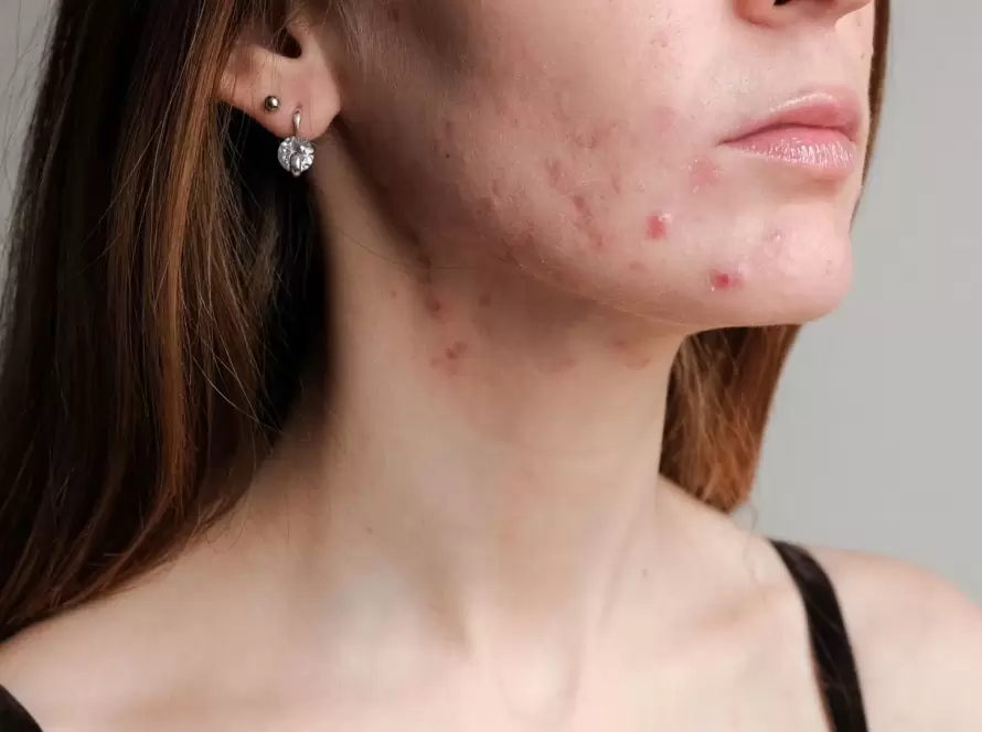 Acne Scars