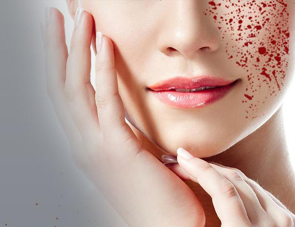 The Top 10 Vampire Facial Treatment Clinics in Delhi.