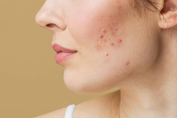 Acne : How to Prevent and Treat Scars – Complete Guide