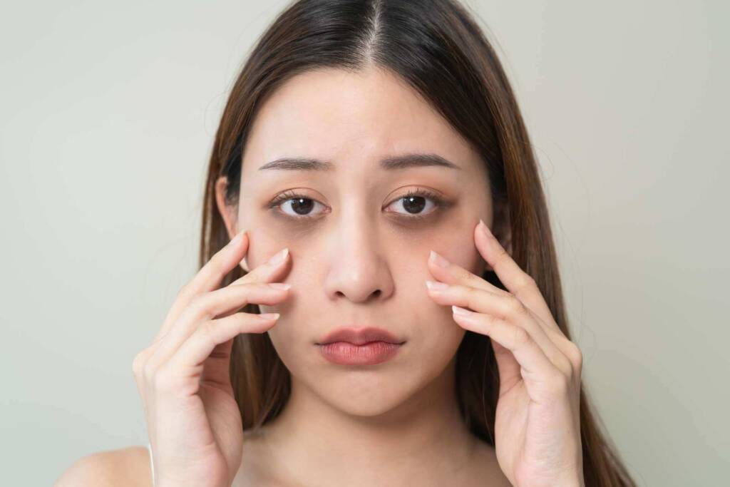 Dark Circles :Uncovering the Link Between Dehydration & Eyes