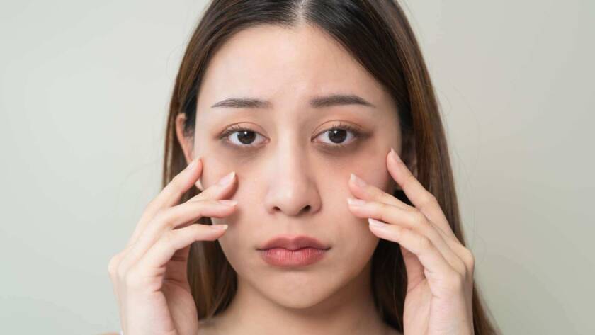 Dark circles treatments