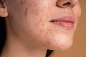 Acne: Effective Treatments for Acne-Prone Skin