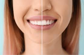 Correcting a Gummy Smile with Effective Aesthetic Treatments