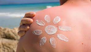 Sunburn Solutions: Prevention and Effective Aftercare