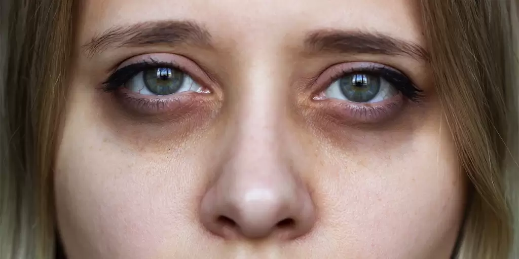 Dark Circles : How Hormonal Changes Affect Their Formation