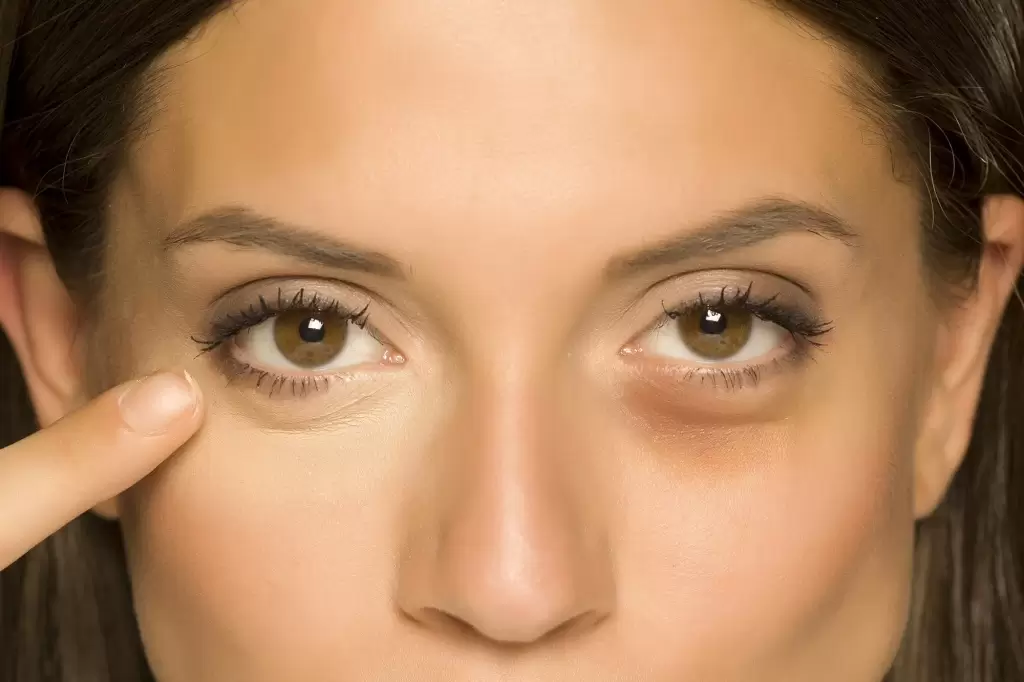 Prevent Under-Eye Bags: Long-Term Maintenance Tips