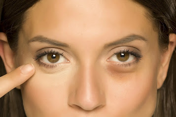 Under-Eye Bags : How Stress & Lack of Sleep Cause Them