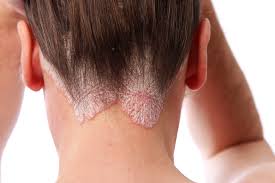 Psoriasis: Understanding and Treating – Complete Guide