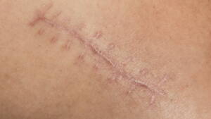 Treatments for Post-Surgery Scars