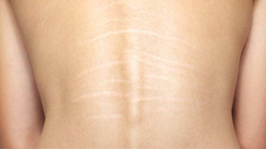 Stretch Mark Reduction: Can You Permanently Remove Them?