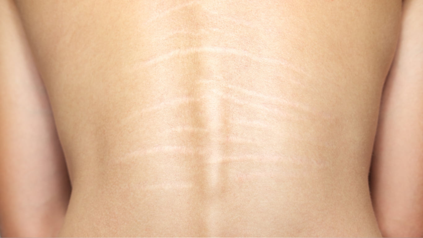 Stretch Mark Reduction