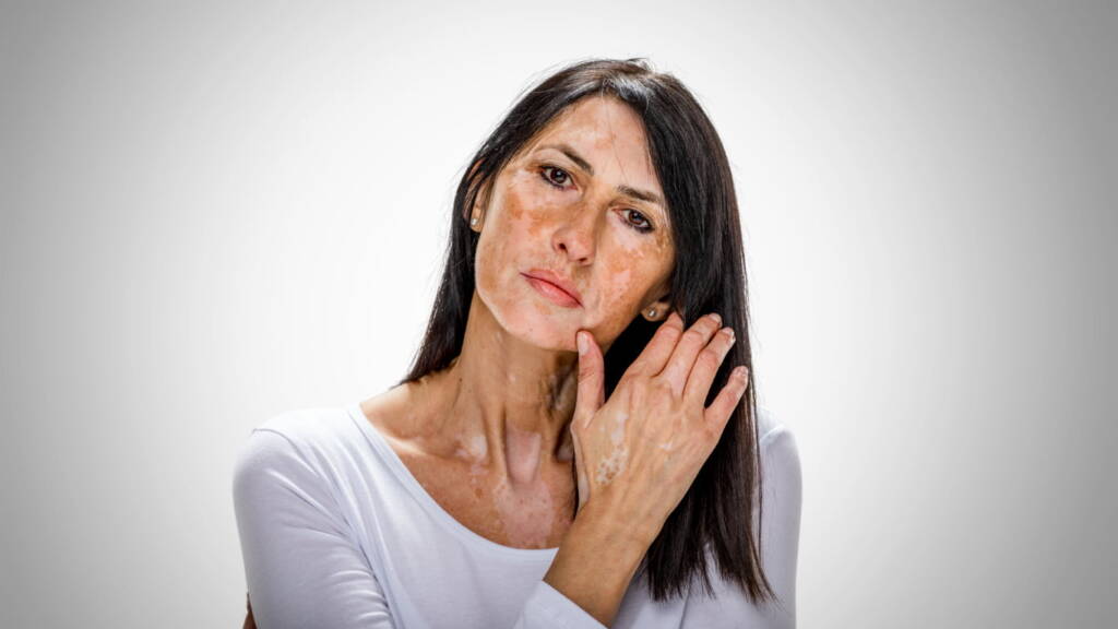 Sun Damage & How to Reverse It with Professional Treatments
