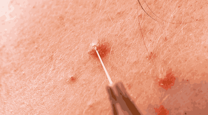 Acne Scars 101: Best Treatments for Clearer, Smoother Skin