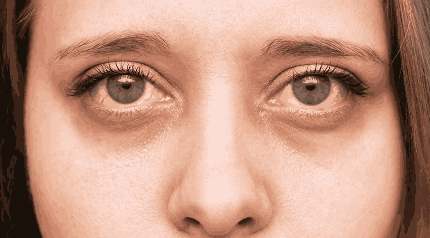 Dark Circles and Under-Eye Bags: Real Causes and Fixes