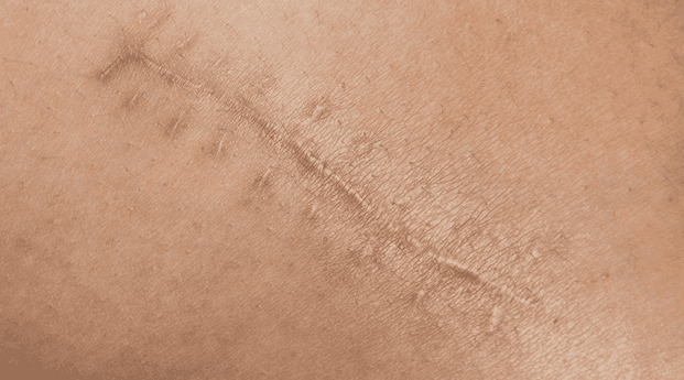 Microneedling for Scars: What to Expect from Your Sessions