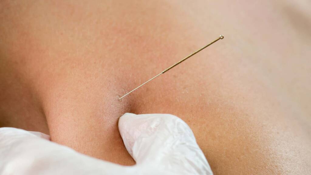 Breakthroughs in Nano-Needling: Is It the Future of Skin Rejuvenation?